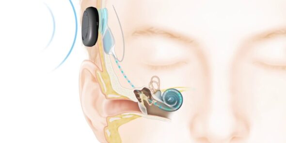 implante-coclear-centro-de-otorrino